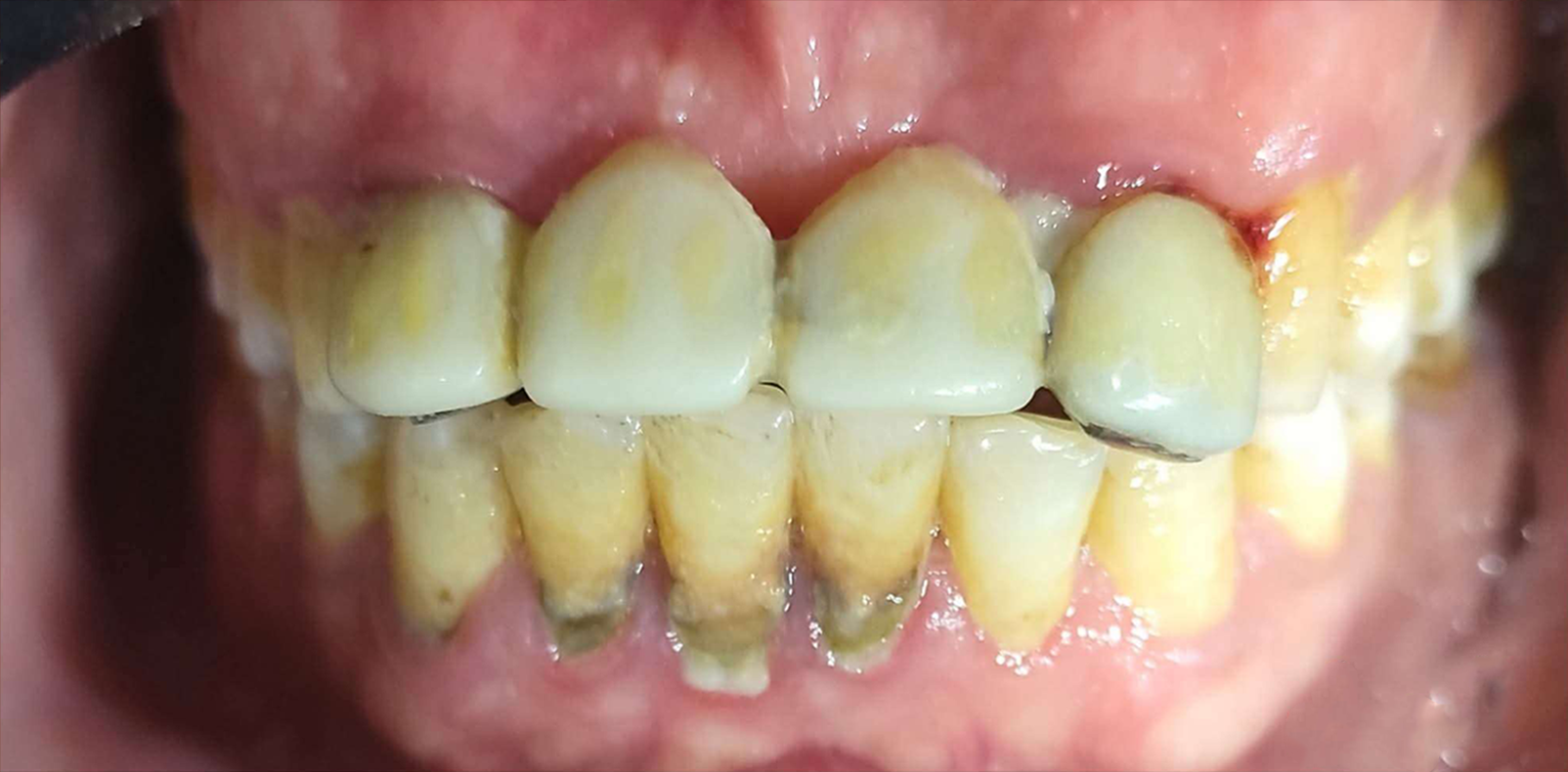 قبل — علاج تسوس طفل في القصاصين